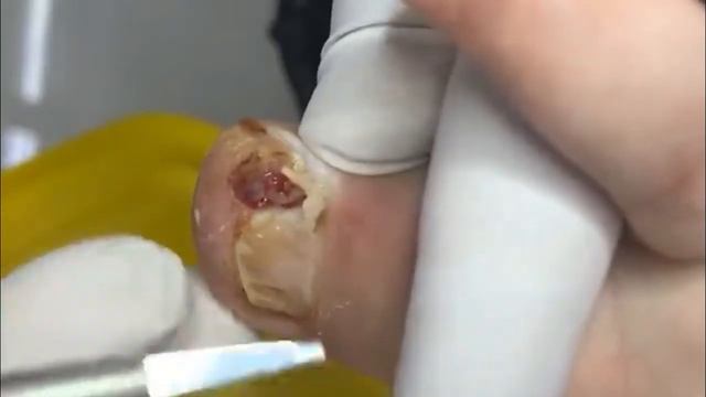 Огромное раздвоение ногтя на внутренней стороне пальца безболезненное восстановление смотреть онлайн