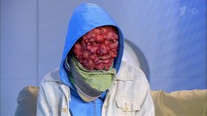 Средневековая болезнь: проказа. Здоровье. Фрагмент выпуска от 13.06.2016