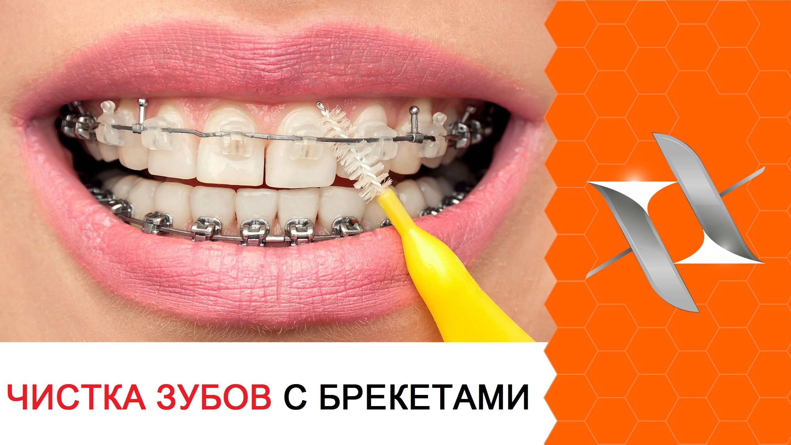 Полный алгоритм чистки зубов с брекетами: 6 шагов.