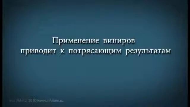 Керамические виниры и ультраниры на зубы