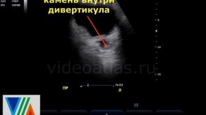 Камень внутри дивертикула МП