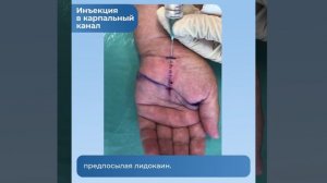 Блокада при синдроме карпального канала. Обучающее видео.