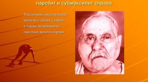 Острые и хронические сиаладениты. Часть 1.