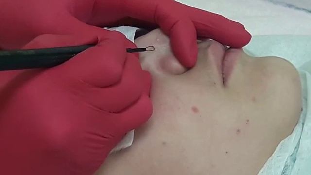 Удаление новообразований на лице.