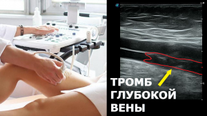 Тромбоз ГЛУБОКИХ вен нижней конечности на УЗИ