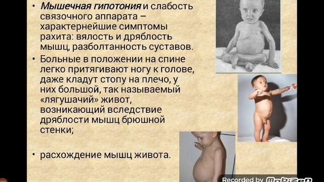 Андижанский государственный медицинский институт лекция Рахит доц.АБДУЛЛАЕВА М Э,