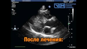 Миокардит (транзиторная кардиомиопатия) у кошки