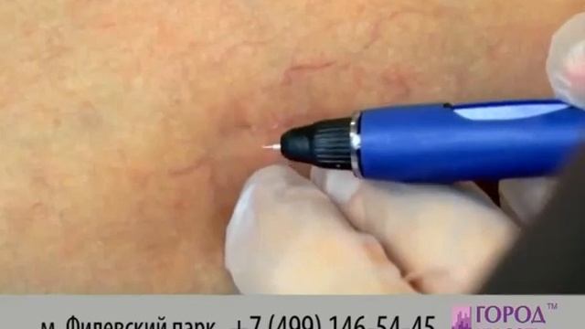 Удаление сосудистой сетки - быстро и навсегда! смотреть онлайн