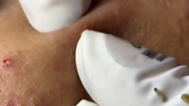 Это ГИГАНТСКИЕ черные точки ДАВИТЬ прыщи смотреть онлайн