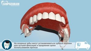 Бюгельные протезы: бюгельный протез на кламмерах