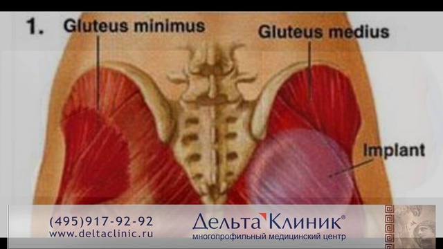 Пластика ягодиц. Глютеопластика.