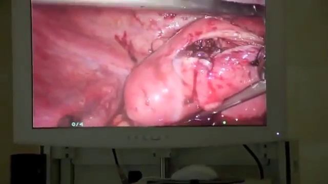 Ушивание раны после миомэктомии при помощи троакара VECTEC смотреть онлайн