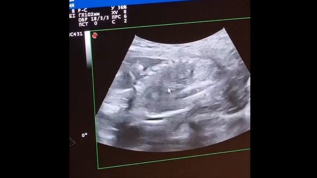 Узнали пол ребенка | УЗИ 18 неделя | Что видно на скрининге второго триместра? 18-21 неделя смотреть онлайн