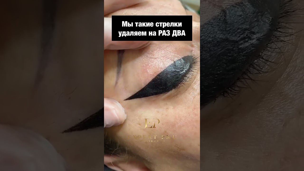 Как можно было сделать такие стрелочки?  #удалениетатуажа