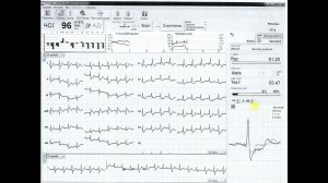 Оценка ишемических изменений (тредмил-тест)