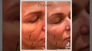 Коррекция губ по индивидуальной методике Др. Гинтер