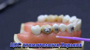 Приклеить брекет в домашних условиях