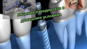 Лечение пародонтоза в домашних условиях