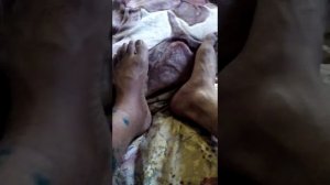 Открытый перелом голени со смещением