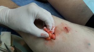 Удаление нескольких липом из одного разреза при липоматозе