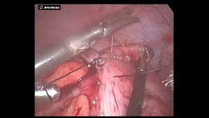 Ретроградная аппендэктомия гангренозный аппендицит