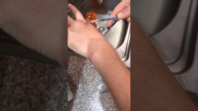 Как я пытался вылечить шишку на руке, которая вылезла непонятно почему минут за 15. смотреть онлайн