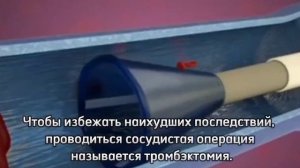 Удаление тромба. Что такое тромбоэмболия?