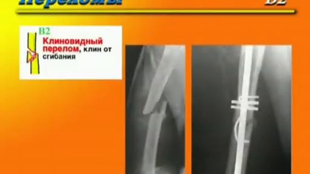 Переломы плечевой кости Fractures of the humerus смотреть онлайн