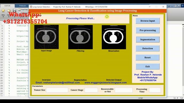 Matlab Source Code for Lung Cancer Stage Detection Using Image Processing