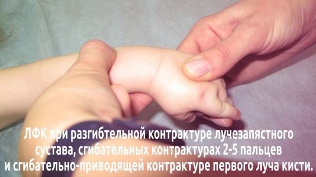 ЛЕЧЕБНАЯ ФИЗКУЛЬТУРА (ЛФК) В РЕАБИЛИТАЦИИ ПАЦИЕНТОВ С АРТРОГРИПОЗОМ  (ЧАСТЬ 2.)