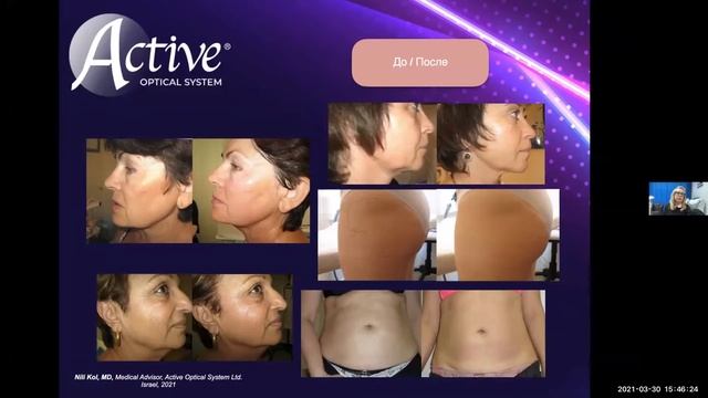 Вебинар по Body Shape RF-311 Quadropolar - Косметологам и специалистам эстетической медицины! смотреть онлайн