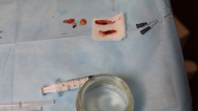 CO2 лазер DEKA для выполнения лазерной блефоропластики смотреть онлайн