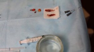 CO2 лазер DEKA для выполнения лазерной блефоропластики