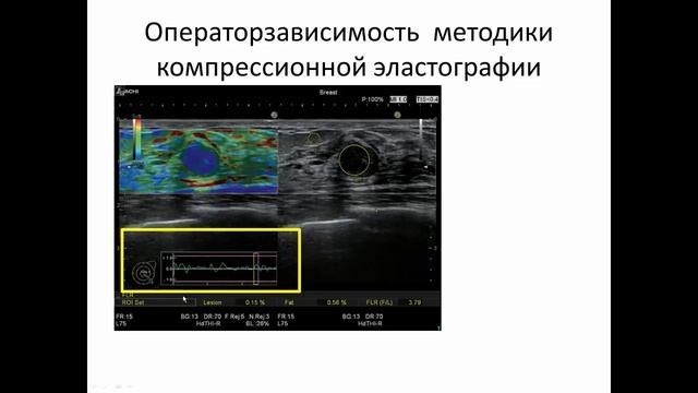 Эластография молочных желез