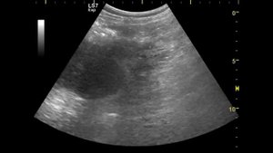 Удвоение почечных лоханок. Камни в мочеточнике