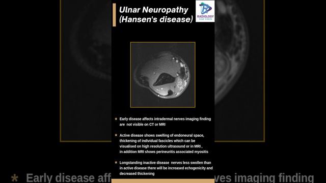 Hansen's disease#Ulnar Nerve thickening#Ulnar neuritis#mri ulnar nerve#nerve thickening.