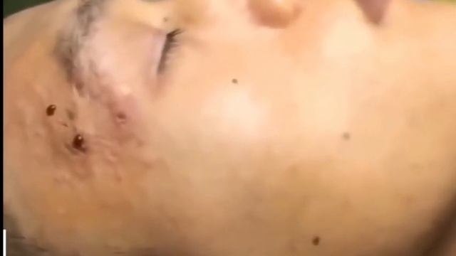 Удаление черных головок и видео с выпивкой прыщей 2021 смотреть онлайн