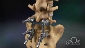 Lumbar Spondylolysthesis Correction Surgery animation