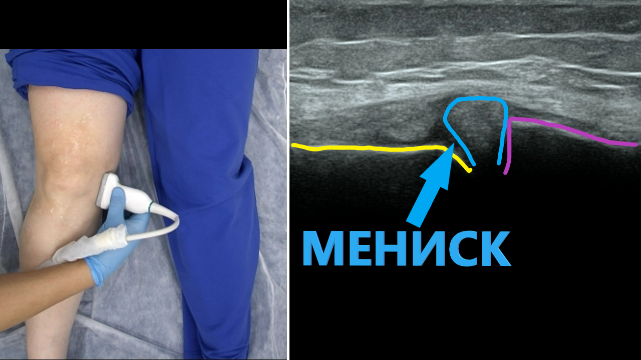 УЗИ коленного сустава смотреть онлайн