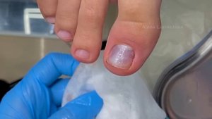 Прокол ногтя / зачем прокалывать ноготь / Подология / Живой прием / ушибла ноготь что делать?