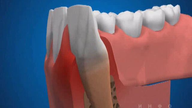 Пародонтит - лечение смотреть онлайн