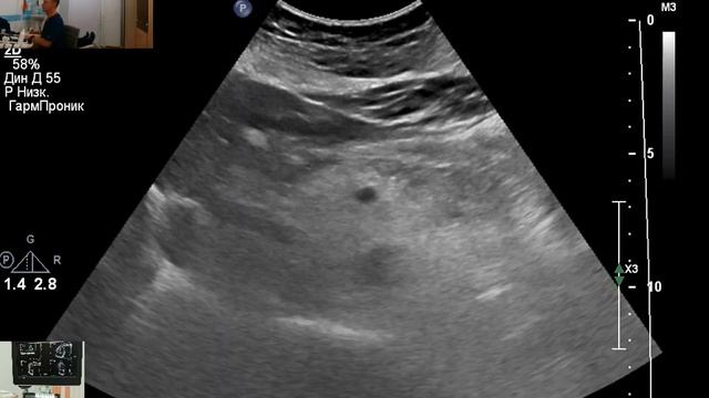 УЗИ желчного пузыря. Дилатация холедоха. смотреть онлайн