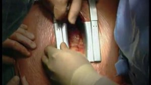 01 Срединная стернотомия