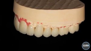 Тотальная реабилитация при помощи E.Мах коронок с облицовкой керамической массой.