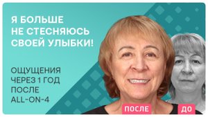 Через год после all-on-4: ощущения реального пациента