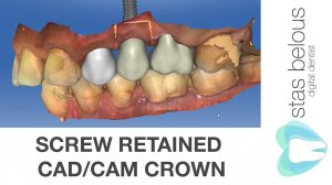 Screw retained Ankylos implant Cad/cam Cerec omnicam Crown Emax Hole block A14S Stas Belous