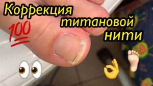 Коррекция титановой нити ????