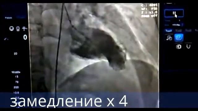 Вентрикулография