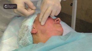 Нитевой лифтинг