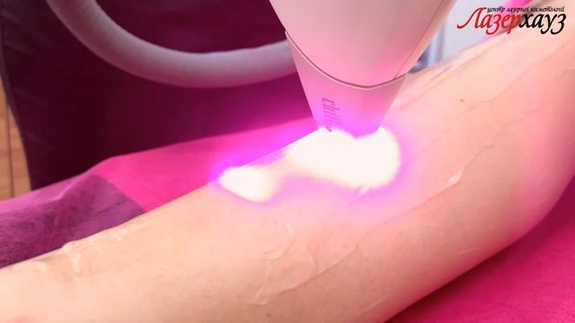 Лазерна епіляція "Золотий Стандарт" смотреть онлайн